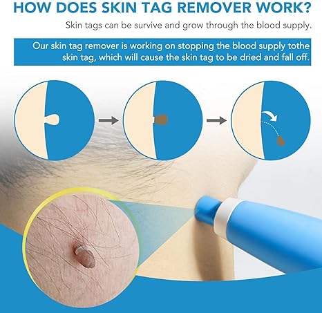 ✨ Acrochordon Skin Tag Remover Kit – 2-in-1 Fast & Painless Solution 🩹💖